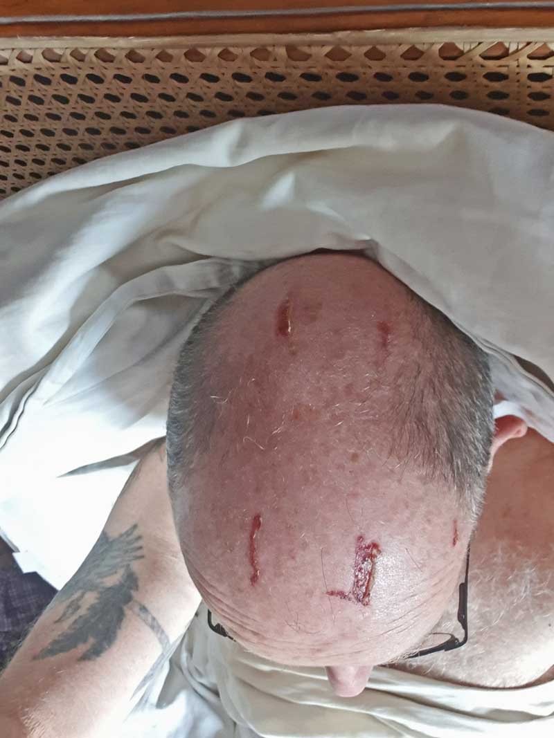 Scalp damage apparently from helmet liner
